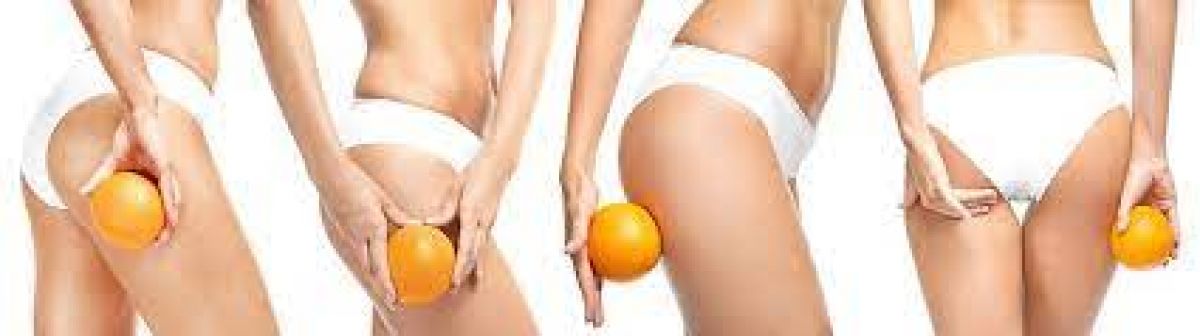 Quel est votre type de cellulite ?